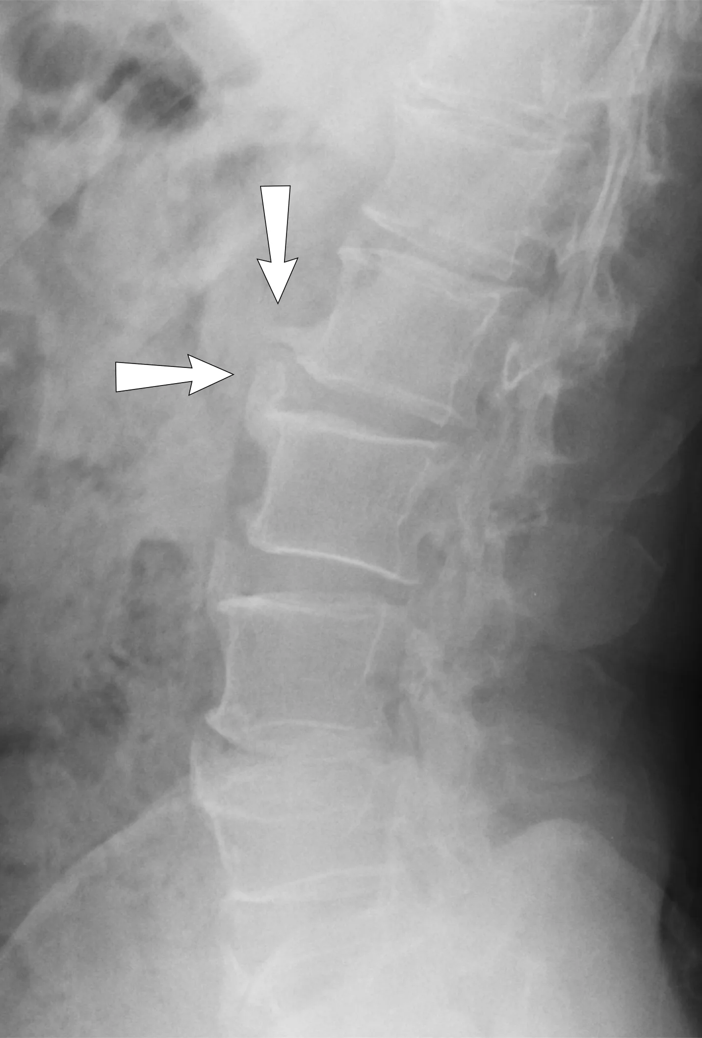 Lateral X-ray of spondylosis of the lumbar spine, with osteophytes marked by arrows.
