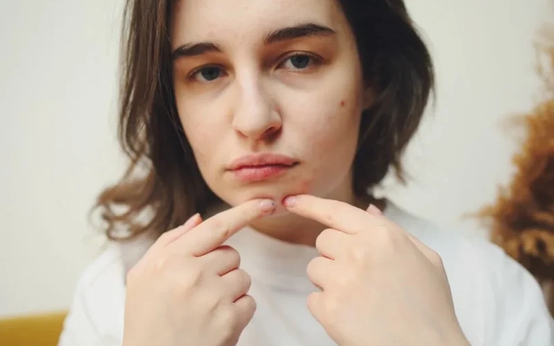 Close-up of a woman with acne touching her face, highlighting skin care concerns.