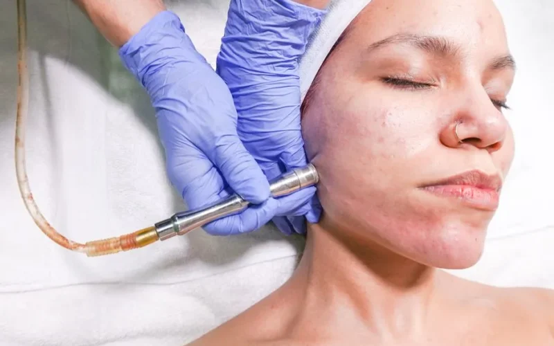 A woman receiving a microdermabrasion facial treatment by a professional with gloved hands.